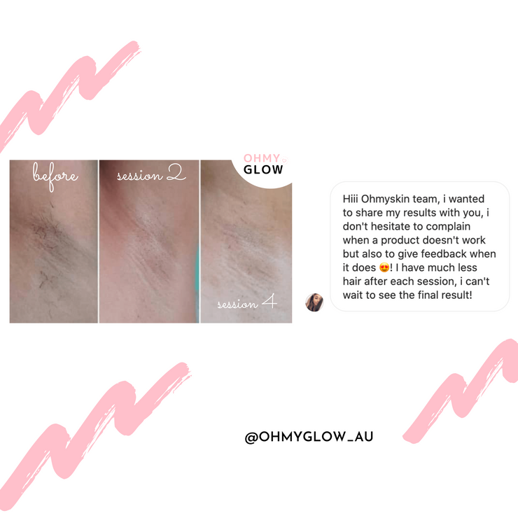 Ohmyglow IPL Hair Removal Handset